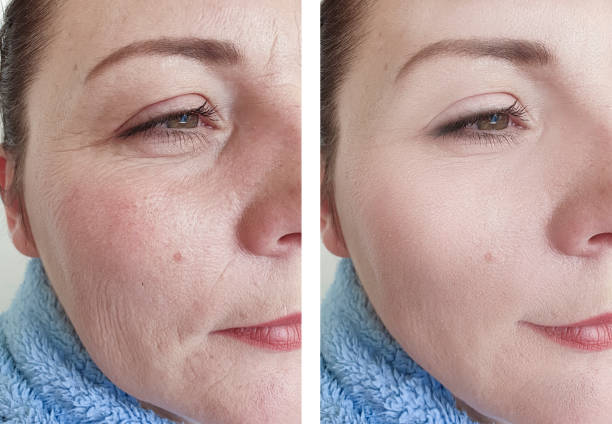Real Elenyra skincare results – before and after using LED mask